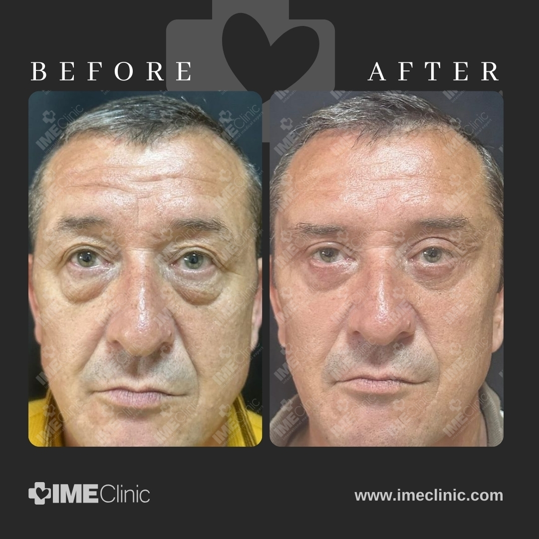 
                                     Side-by-side images of a mans face labeled Before and After. The After image shows reduced wrinkles, smoother skin, and a more rested appearance. A heart shape is subtly visible in the background. Text at the bottom reads IME Clinic and www.imeclinic.com.
